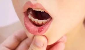 5-Effective-Ways-to-Heal-Your-Childs-Canker-Sores-at-Home.jpg
